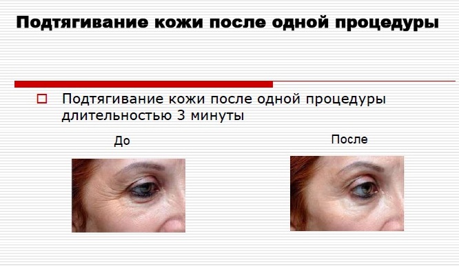 Аппарат радиочастотной электротерапии Галатея 