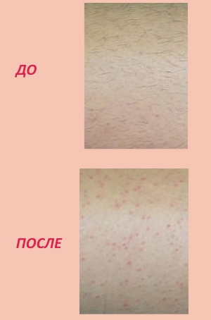 Аппарат для электроэпиляции Полли 